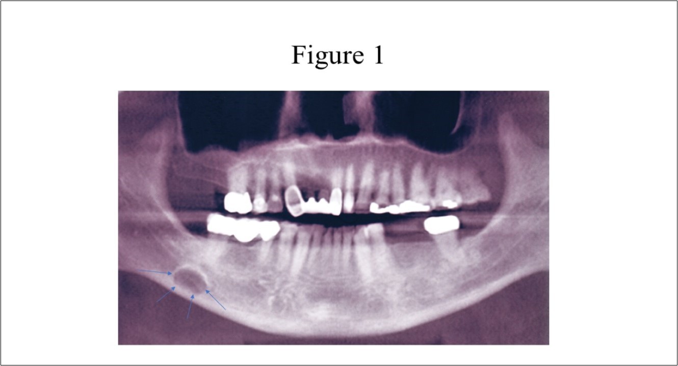 Panoramic radiograph of classically described SBC of the right posterior mandible illustrates the well-defined unilocular radiolucency in the right posterior mandible between the inferior alveolar canal and the inferior border of the mandible (arrows).