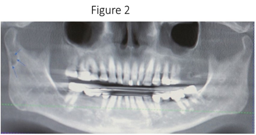 Panoramic radiograph reveals a unilocular radiolucency in the right subcondylar neck of the mandible which is considered a variant of the classic SBC described by Dr. Stafne.