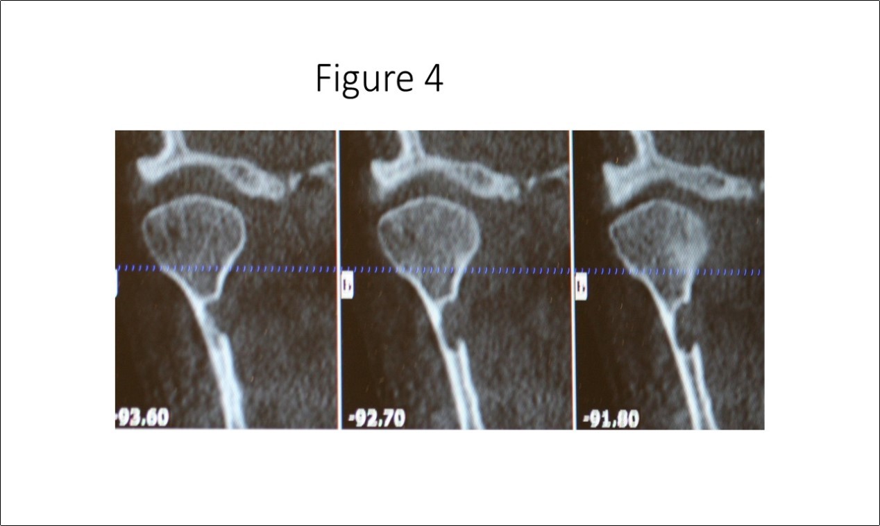 Cone beam CT TMJ sagittal views illustrate osseous defect on medial cortex. Note the thinness of the cortex that places the patient at risk for fracture of the condylar neck.