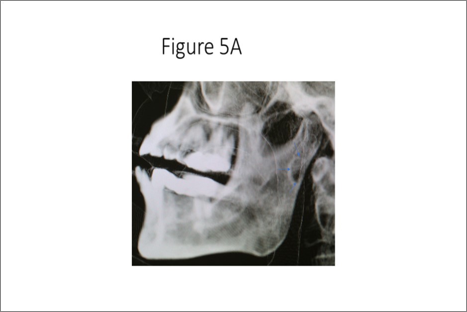 Three-dimensional cone beam CT scan reconstruction revealing osseous defect in medial cortex of right subcondylar neck of mandible.