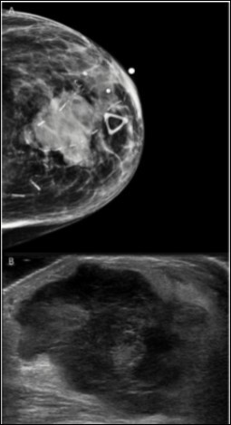 Radiological Findings. Radiographic imaging of the breast revealed a heterogeneous, hypoechoic solid mass with vascularity measuring 3.3 cm with associated thickening of the skin. A. Tomography, B. Ultrasound