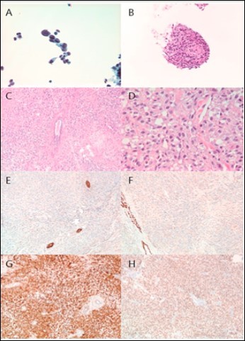 Histopathological Findings. Fine needle aspiration revealed spindled, pleomorphic cells with numerous mitoses and apoptotic bodies. The cells were negative for cytokeratins and markers of breast, gastrointestinal, and hepatobiliary differentiation. Microscopic examination of the resected tumor revealed a poorly differentiated neoplasm with predominantly spindled morphology and diffuse expression of markers of melanocytic differentiation. A. Thinprep (40x), B. Cell block (H&E, 20x), C. H&E (10x), D. H&E (40x), E. Pan-cytokeratin (10x), F. GATA3 (10x), G. S100 (10x), H. SOX 10 (10x).
