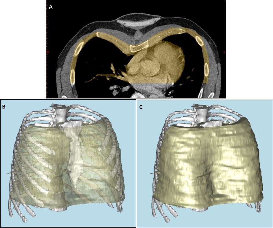 a) Anterior portion of axial computed tomography image of thorax, demonstrating pectus excavatum, with portion used for reconstruction highlighted in yellow. b) and c) three dimensional computer-aided reconstruction of the chest wall model.