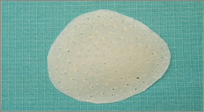 A custom prosthesis with holes pierced in the surface to prevent capsulation and migration.