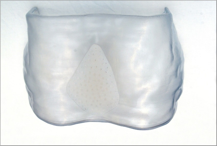 Demonstration of the implant position on a reconstructed model of the thorax