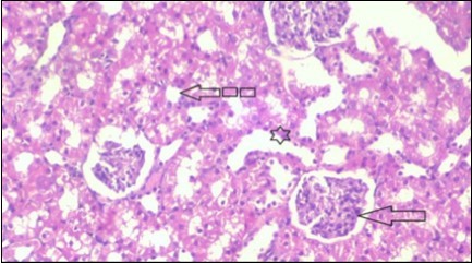 Photomicrogragh of kidney section of treated rat with both Fenugreek and Glimepiride showing improved cortical tissue with most of both Bowman,s capsules (arrow) and proximal tubules (dash-arrow) with nearly normal structure .Note distal tubules still suffering (star). (H&E) (40X).