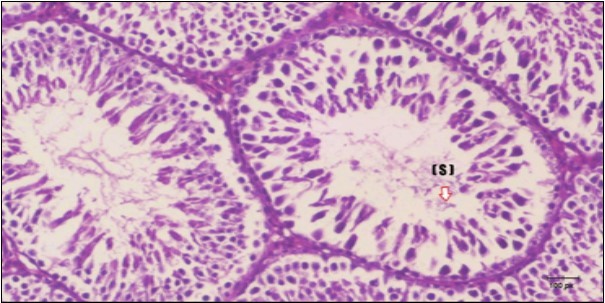 Photomicrogragh of testis section of diabetic rat showing the sloughing of germ cells towards lumen of seminiferous tubules, absence of spermatozoa with low height of germinal epithelium and congested wide interstitial tissue (star). (H&E) (40x).