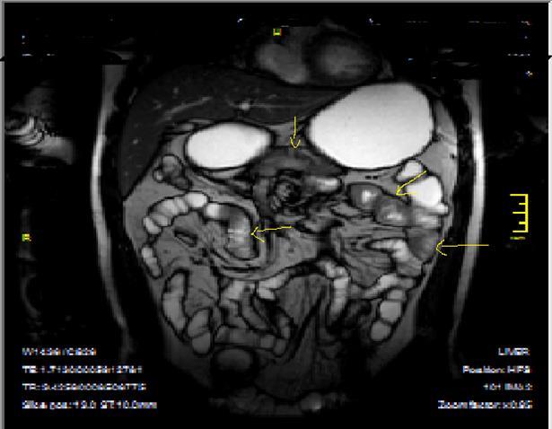 Heterogeneous bowel wall and mucosa involvement with collaborating skip lesions, specific for Crohn’s disease, predominant in ileum and terminal ileum which are shown at T2W coronal sequence after OCA, regarded at 39 years old female with severe disease.