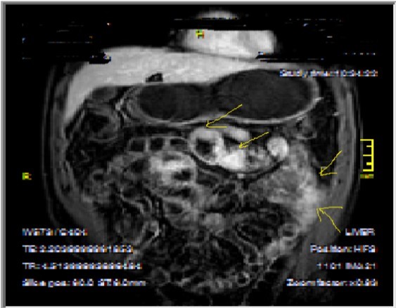 İrregular bowel wall and luminal enhancement of ileum, with loss of valvula conniventes on T1W coronal post-contrast sequence, seen on 26 years old male with moderate inflammatory bowel disease.