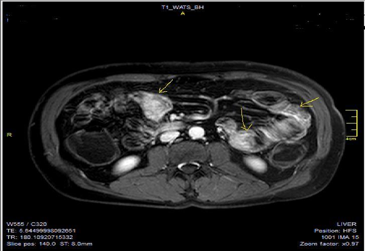 Diffuse homogeneous contrast enhancement on the bowel wall and mucosa due to Crohn’s disease, seen at T1W post-contrast axial image, indicated at 23 years old male with mild disease status.