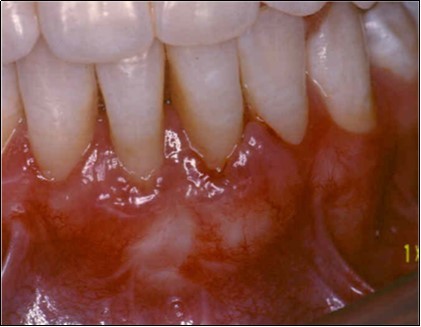 Postoperative after 2 years.