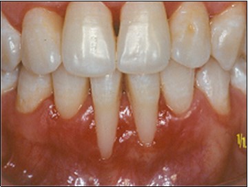 After initial therapy