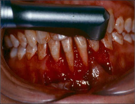 Er-Yag laser being applied to promote root biomodification