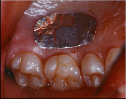 Donor site area in the palate