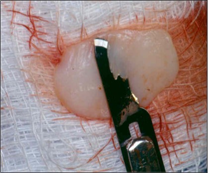 Elimination of the epithelium from free gingival graft by acute dissection