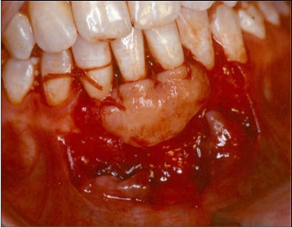 Subepithelial graft sutured over exposed roots surfaces