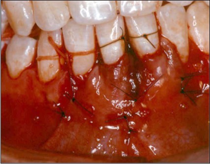 The partial thickness flap sutured over subepithelial graft