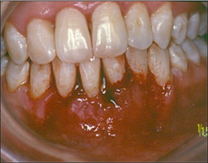 Postoperative after 7 days