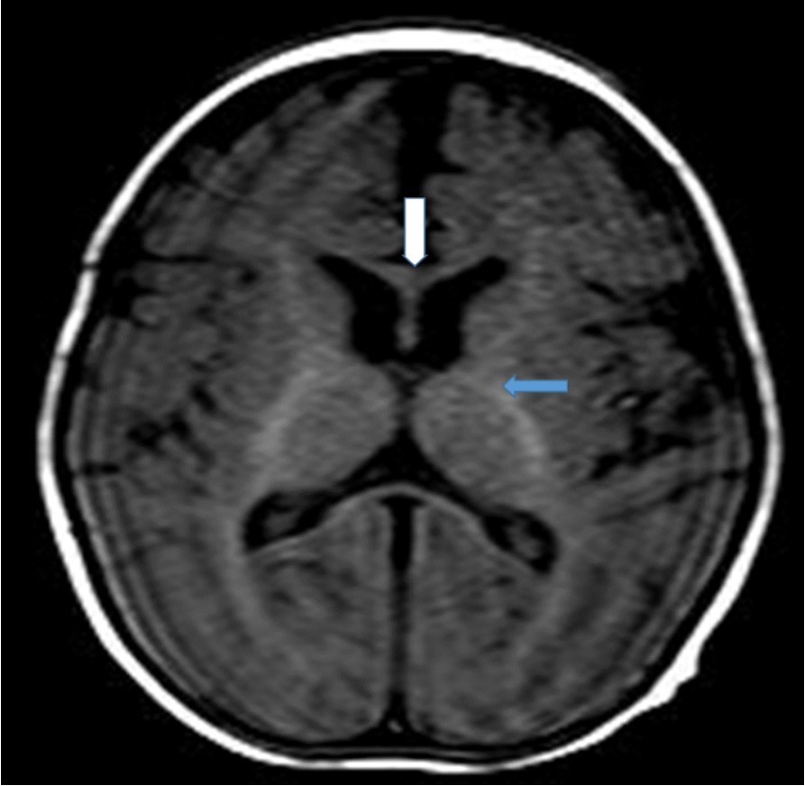 T1-weighted magnetic resonance image of the patient (7-month-old girl). The genu of the corpus callosum is hypointense due to myelination delay. In this age group, the genu of the corpus callosum should become hyperintense similar to the posterior limb of the internal capsule (blue arrow) due to myelination.