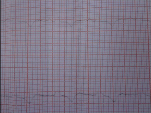 Electrocardiogram: epicardial ischemia in the infero-lateral territory.