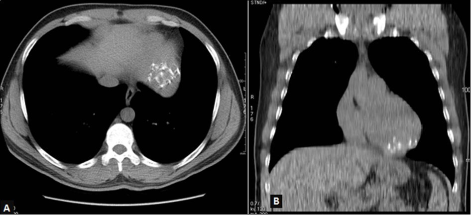 Thoracic CT without injection, mediastinal window, axial view (A) and coronal reconstruction (B): left ventricular mass with multiple calcifications in strata.