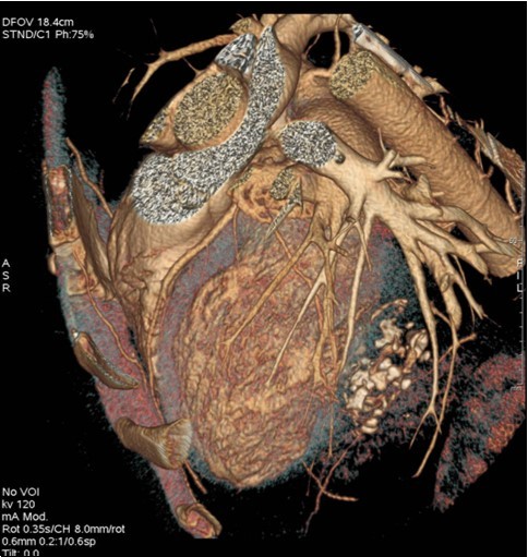 Coroscanner with three-dimensional reconstruction: intra-myocardial mass of left ventricle with multiple calcifications.