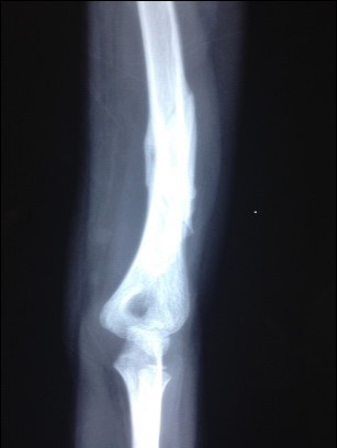 Same patient after LLLT administration. Notice the fracture ends re-modelled nicely and fracture had solidly healed