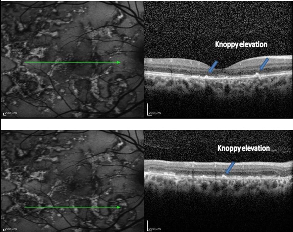 FAF (left) and corresponding eye-tracked SD-OCT image (right) of patient 1 during healing stage of the right eye shows hyperreflective knobbly elevations of the outer retinal layers. The RPE, the POST, IS/OS junction, and the ELM could not be distinguished. The ONL appeared normal with increased reflectance from the choroidal layers.