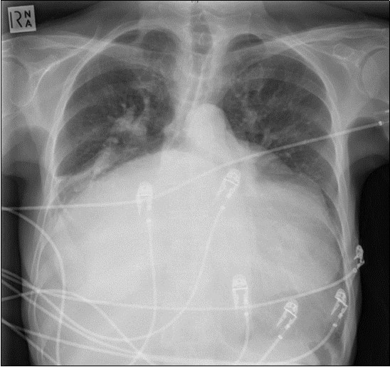 Chest X-ray Antero-posterior view. Findings showing enlarged left atrium, splaying of the carina, hilar venous congestion