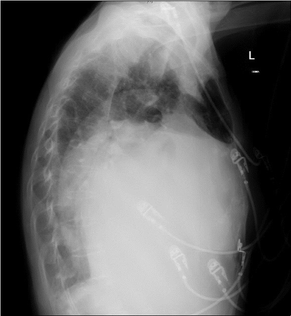 Chest X-ray Lateral view. Findings showing enlarged left atrium occupying large amounts of the thoracic cavity, both horizontally and vertically