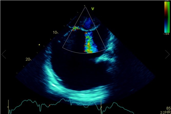 Transthoracic echocardiogram Apical 4C view. Findings include severely enlarged left atrium, severe mitral stenosis with associated regurgitation, a mean gradient across the valve of 11mmHg with a hyperdynamic left ventricle