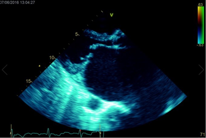 Transthoracic echocardiogram Parasternal long axis view. Findings include severe mitral stenosis (‘hockey-stick’ appearance to mitral valves), raised left atrial pressure (interatrial septum fixed and bowed to right)
