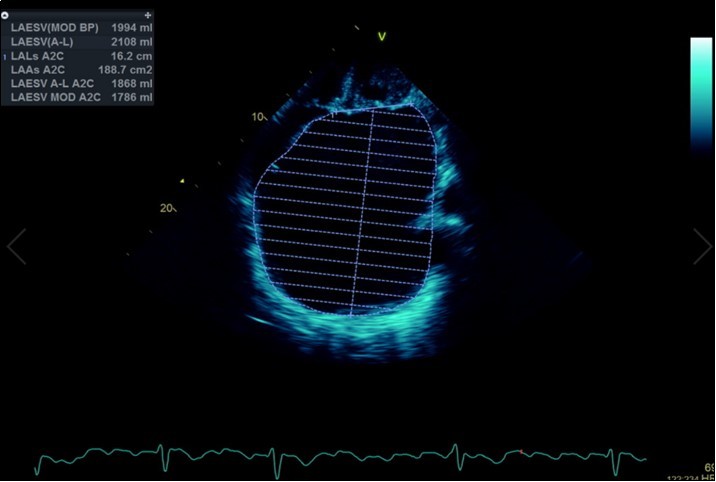 Transthoracic echocardiogram Apical 2C view. Left atrial size estimation by Simpson’s biplane method from apical 2C view. Severely enlarged left atrium (estimated 2108ml, 1548.5ml/m2)