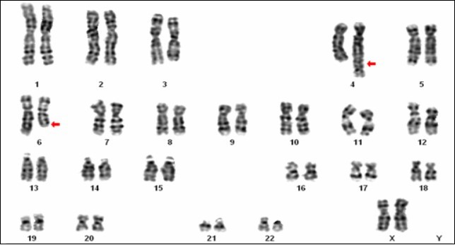 Karyotype showing the balanced translocation 46, XX, t (4;6)(q35;q22)