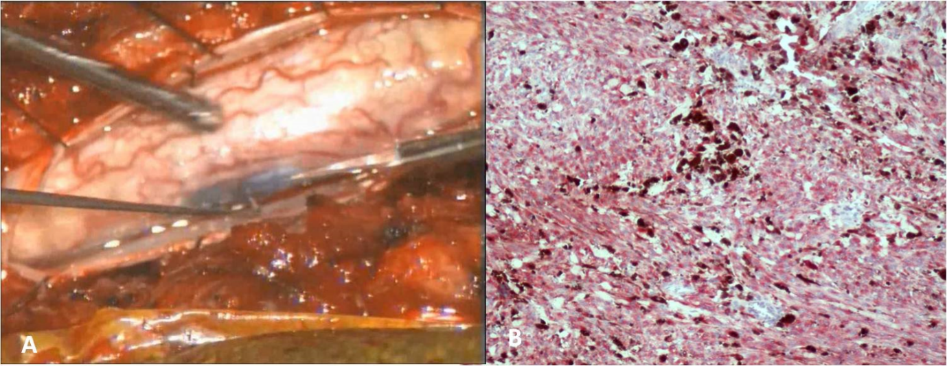 A) Intraoperative picture. B) Photomicrograph of the bleached tumor cells displaying immuno-positivity for HMB-45.