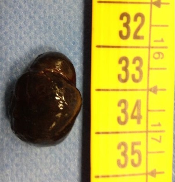 the black and rigid tissue removed en block