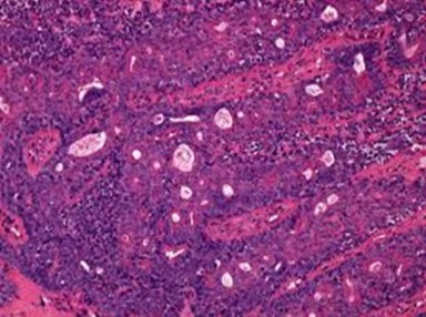 Solid aggregates of tumour cells and duct structures in eccrine porocarcinoma (14).