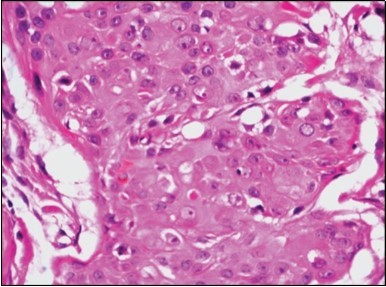 Duct like configurations and atypical epithelial cells with prominent mitosis in eccrine porocarcinoma (22).