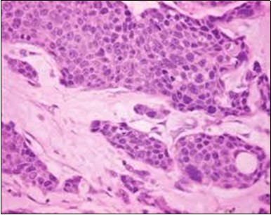 Eccrine porocarcinoma displaying cords and strands of atypical epithelial cells with glandular arrangements (23).