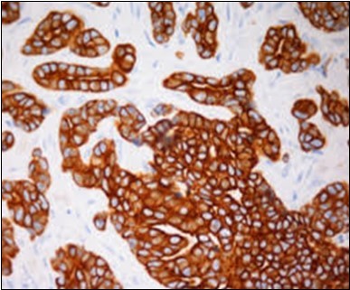 Immune reactivity to cyto-keratin (CK7) in eccrine porocarcinoma(24).