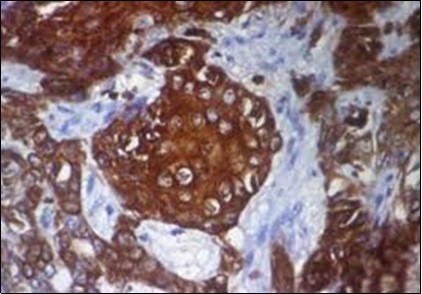 Immune reactivity to CK6 in eccrine porocarcinoma(25).