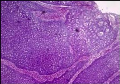 Cohesive accumulations with numerous ductular articulations of carcinoma cells in eccrine porocarcinoma (15).