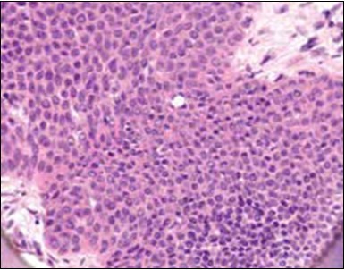 Cellular atypia, mitosis and focal necrosis in eccrine porocarcinoma(16).