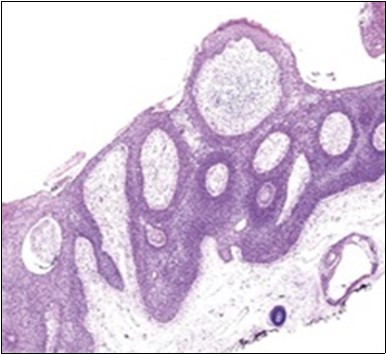 Sweat glandular articulations and malignant cellular aggregates with cystic spaces in eccrine porocarcinoma(17).