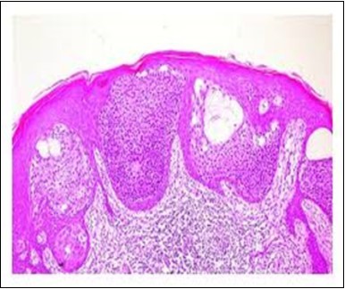Epidermal continuity with aggregates of atypical, solid and cystic epithelial cell nests in eccrine porocarcinoma (18).
