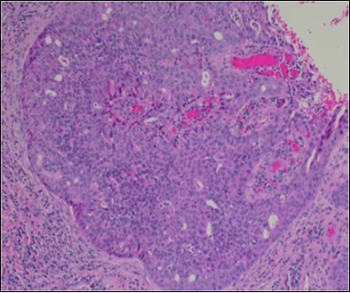 Aberrant and malignant epithelium with cellular proliferation and pleomorphism in eccrine porocarcinoma with frequent mitosis(19).