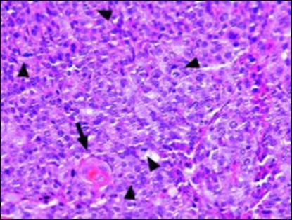 Disseminated atypical epithelial cells with cellular and nuclear pleomorphism, hyperchromasia, indistinct cytoplasm, vesicular nucleoli and central keratinization in eccrine porocarcinoma(20).