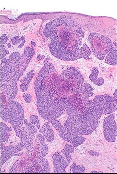 Branches and cords of malignant epithelial cells in eccrine porocarcinoma with a superficial, abutting epithelium and mitotic figures(21).