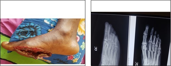 Open fracture of the shafts of the right 2nd, 3rd ,4th and 5th metatarsals, treated by normal saline irrigation, debridement and kirchner wire stabilisation.