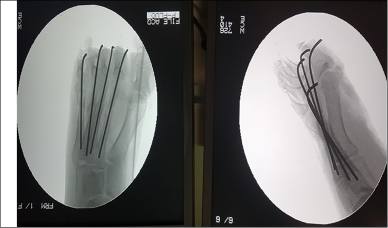 Check x-rays, anteroposterior and lateral views of the open right metatarsal fracture in figure 1, showing stabilization with 2.0-mm kirchner wires.